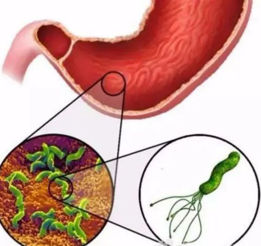 What is Helicobacter pylori? Can Helicobacter pylori cause stomach disease?